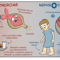 Nursing care for nephrotic syndrome