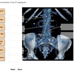 Label the abdominal arteries in the ct angiogram